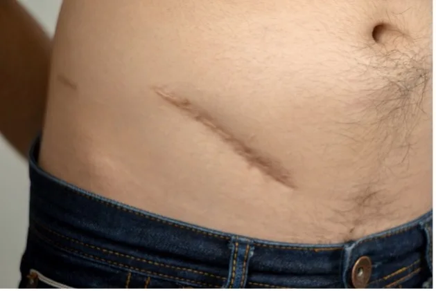 Operationsnarbe am Bauch